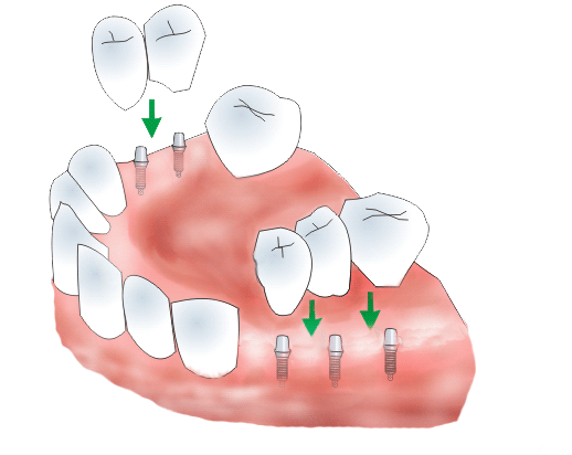 Dental Bridge on Implants