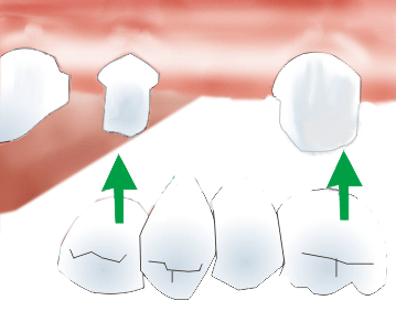 dental bridge