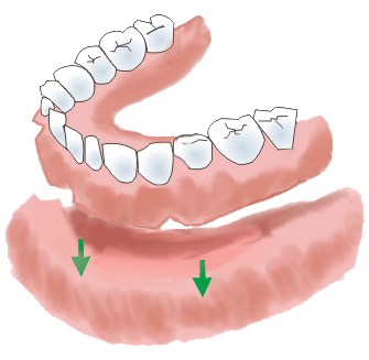 Full Denture