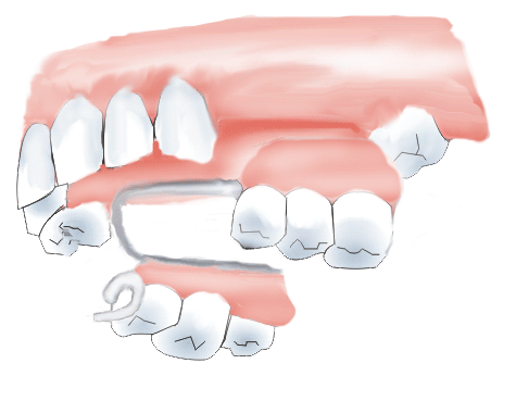 Partial Denture