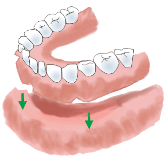 Immediate Denture